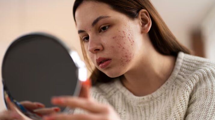 Jerawatan Usai Ganti Skincare Belum Tentu Purging, Kenali Perbedaannya dengan Breakout